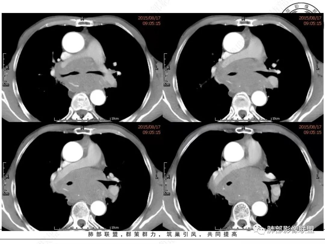 【病例】小细胞肺癌？套细胞淋巴瘤？-13