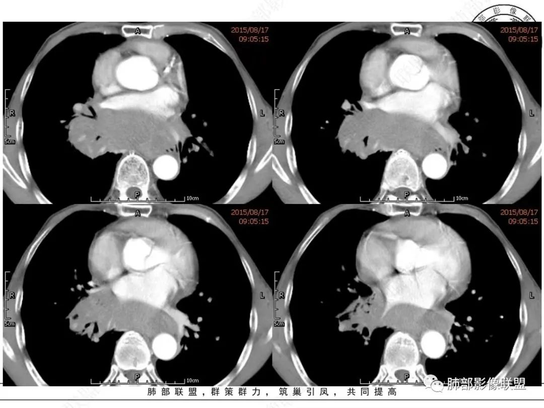 【病例】小细胞肺癌？套细胞淋巴瘤？-15