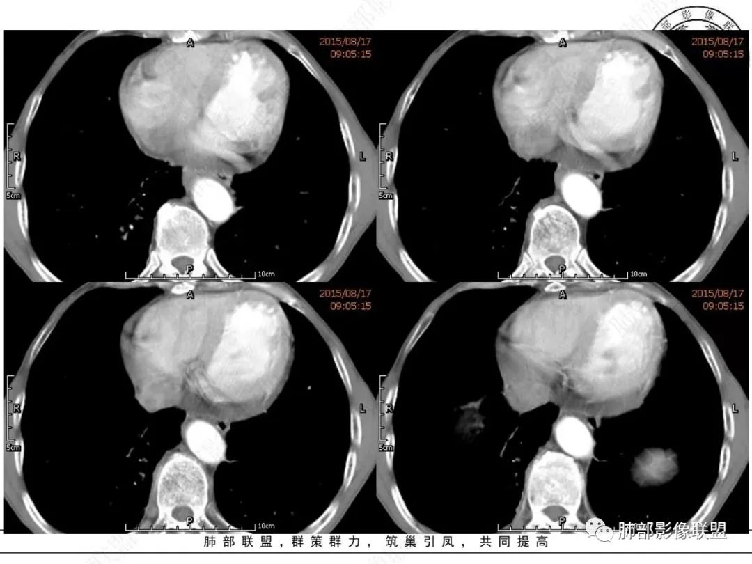 【病例】小细胞肺癌？套细胞淋巴瘤？-17