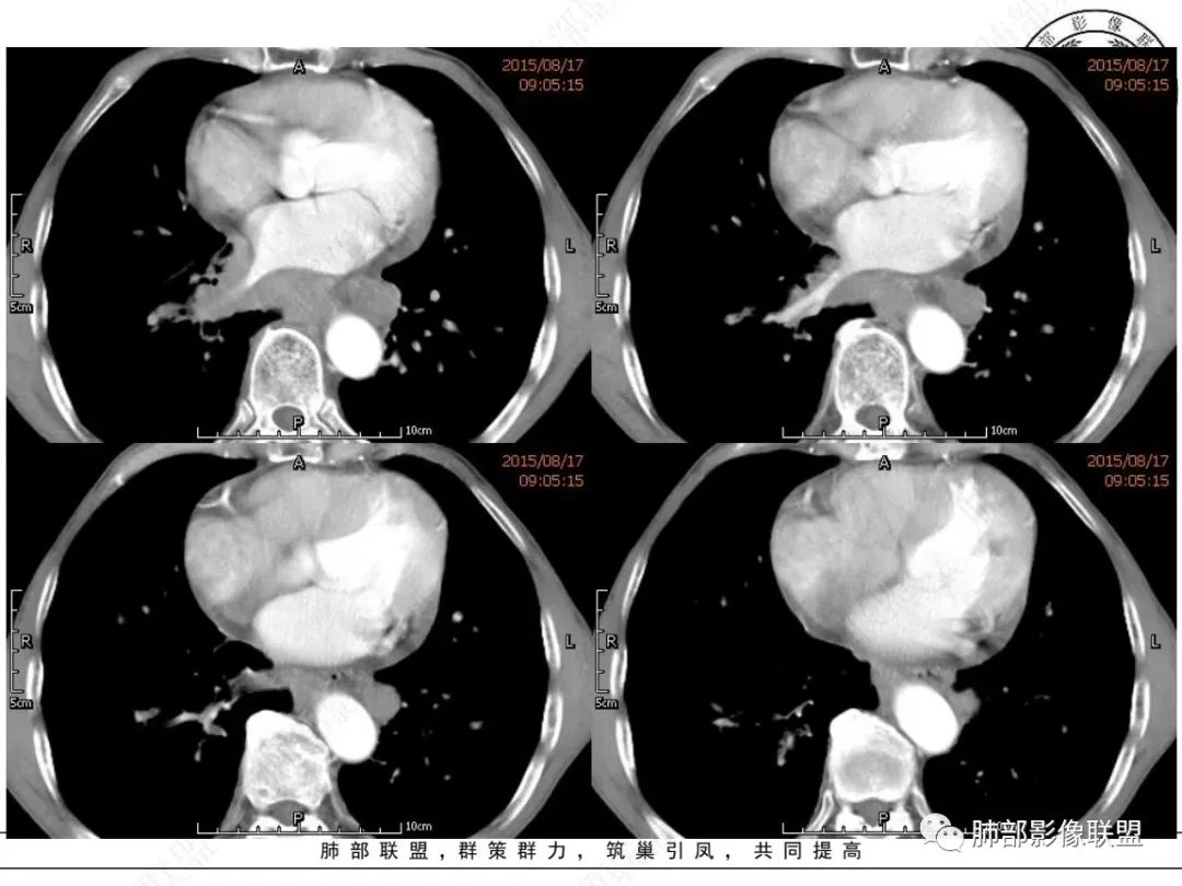 【病例】小细胞肺癌？套细胞淋巴瘤？-16