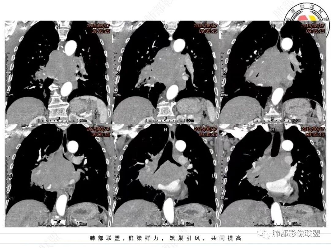 【病例】小细胞肺癌？套细胞淋巴瘤？-18