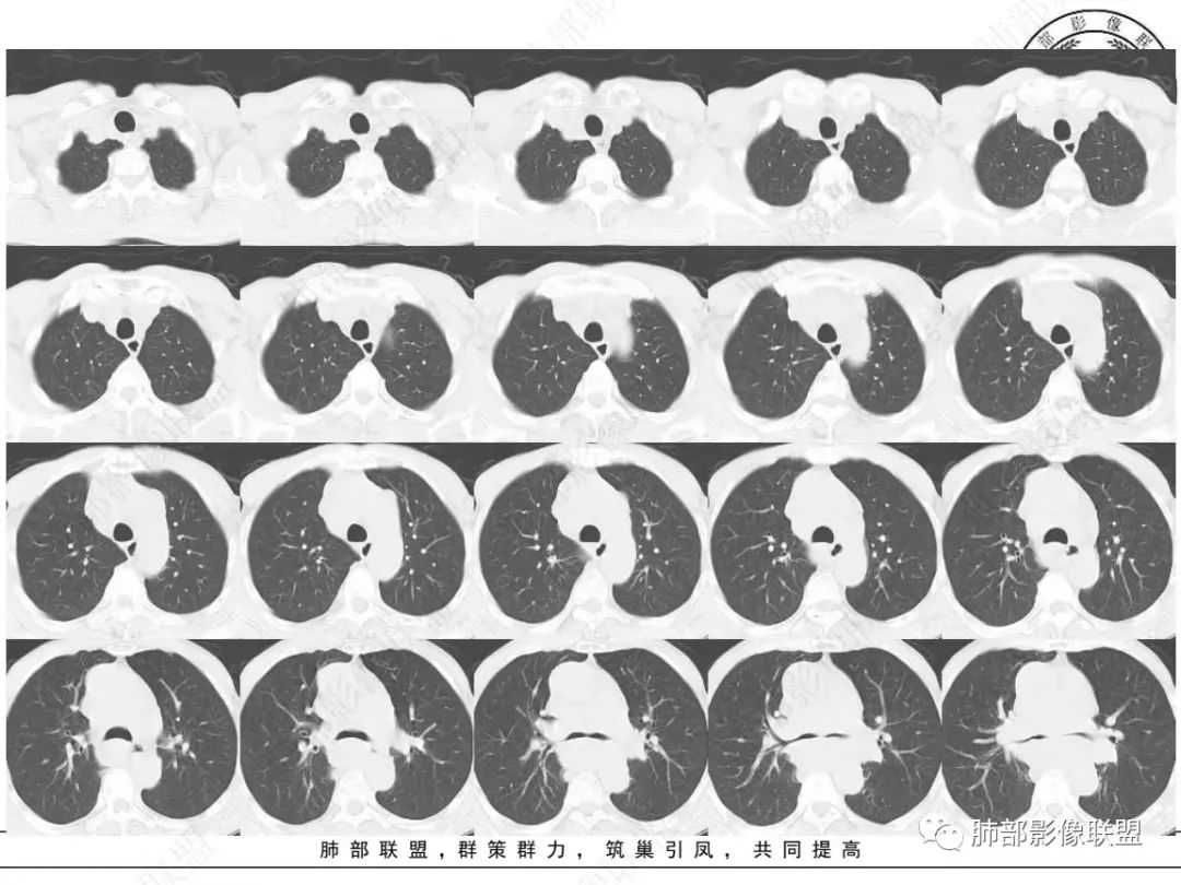 【病例】小细胞肺癌？套细胞淋巴瘤？-19