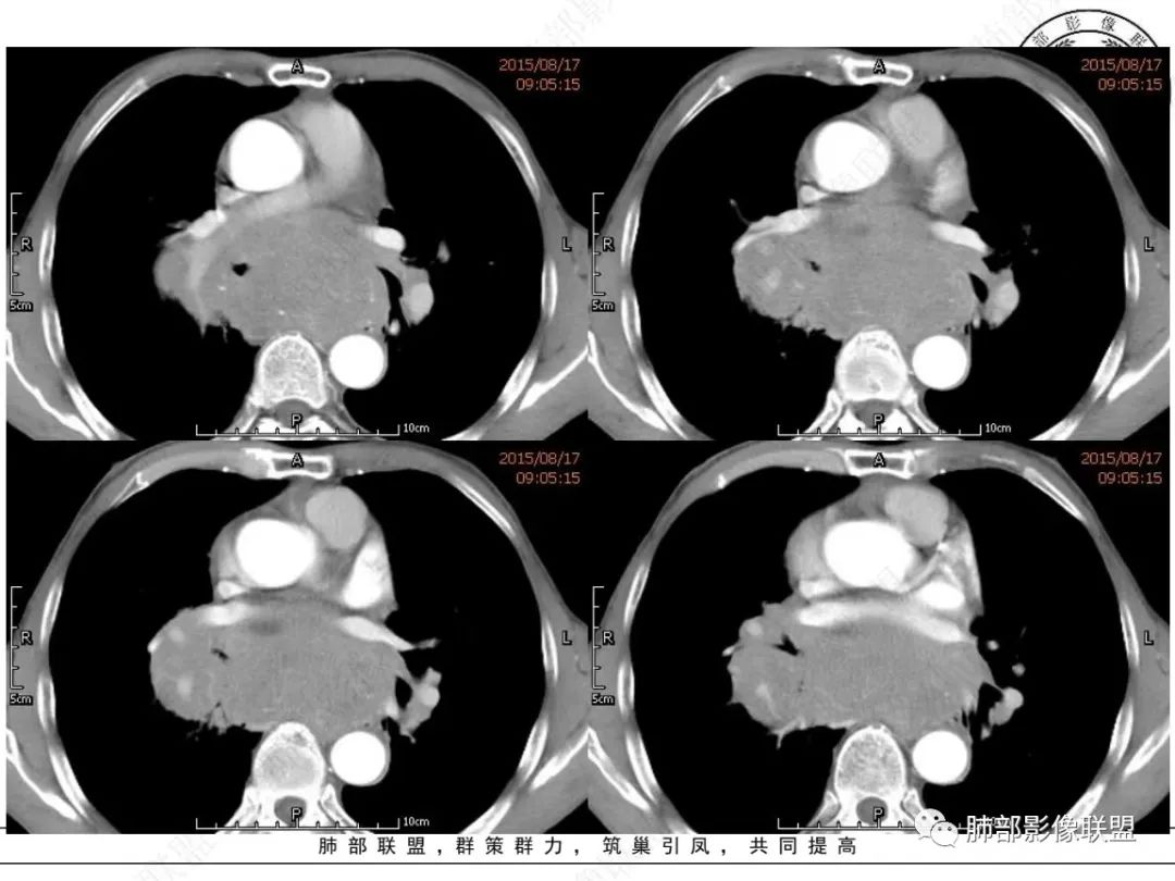 【病例】小细胞肺癌？套细胞淋巴瘤？-14