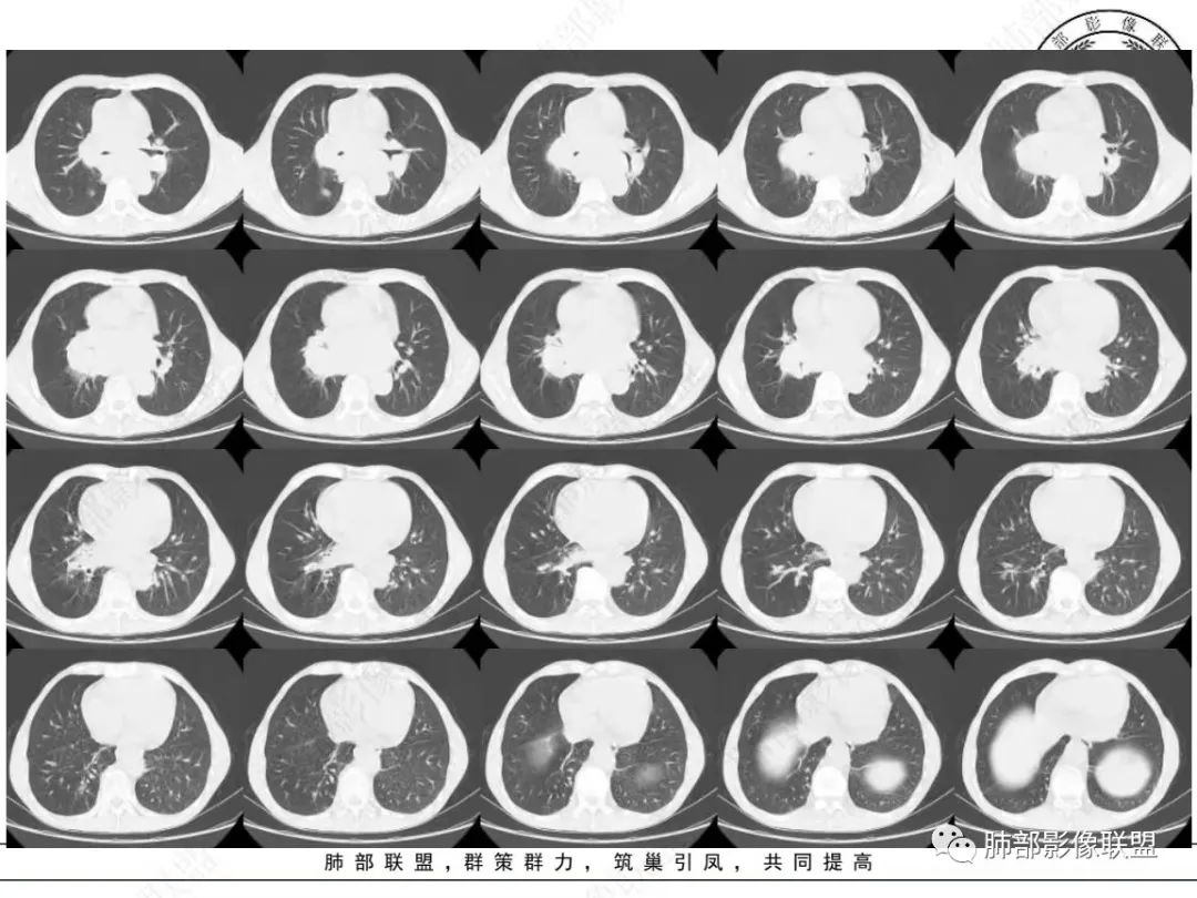 【病例】小细胞肺癌？套细胞淋巴瘤？-20