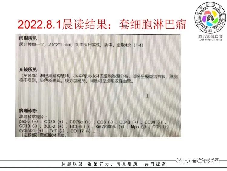 【病例】小细胞肺癌？套细胞淋巴瘤？-23