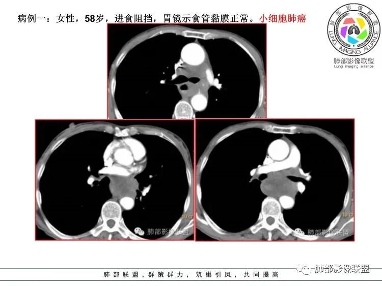 【病例】小细胞肺癌？套细胞淋巴瘤？-26