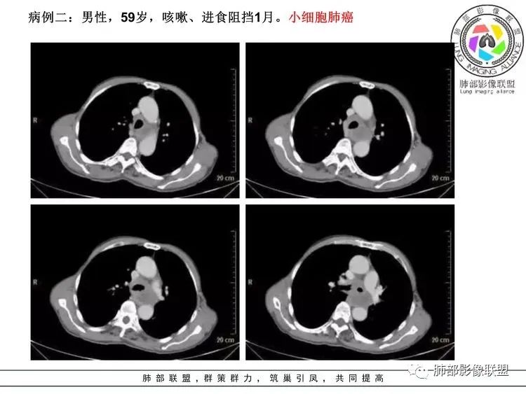 【病例】小细胞肺癌？套细胞淋巴瘤？-27