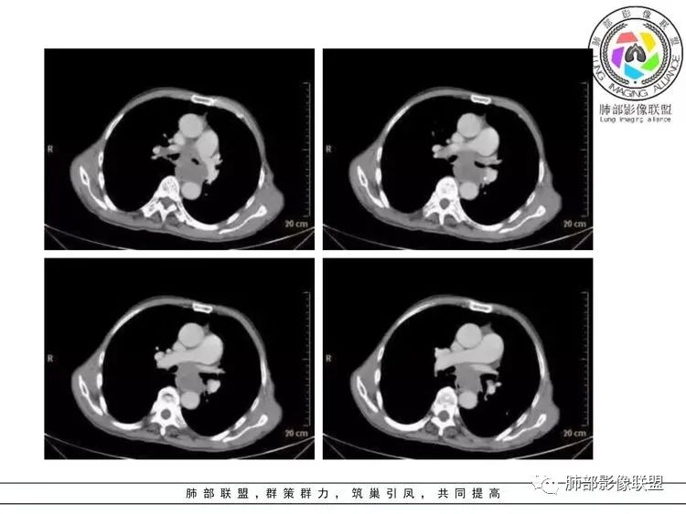 【病例】小细胞肺癌？套细胞淋巴瘤？-28