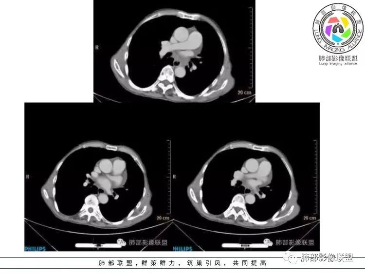 【病例】小细胞肺癌？套细胞淋巴瘤？-29
