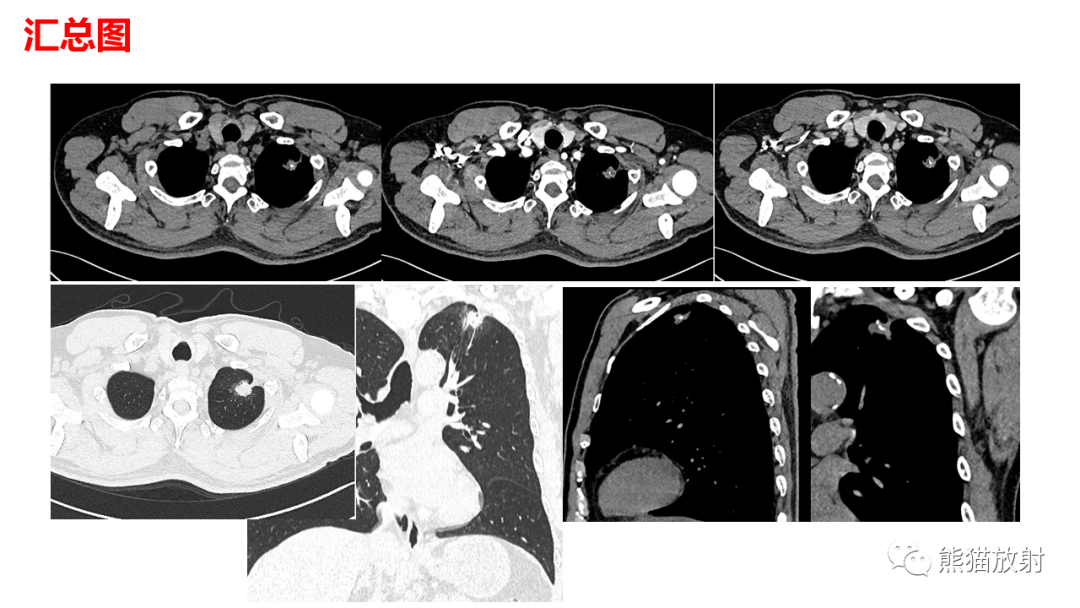 【病例】肺原位腺癌 VS 浸润性腺癌-3