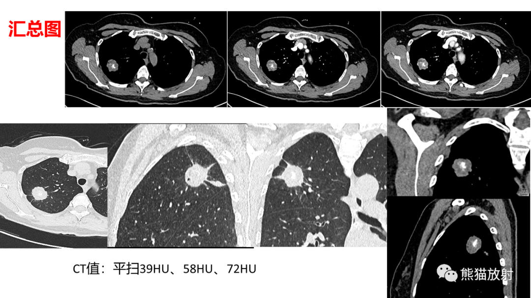 【病例】肺原位腺癌 VS 浸润性腺癌-6