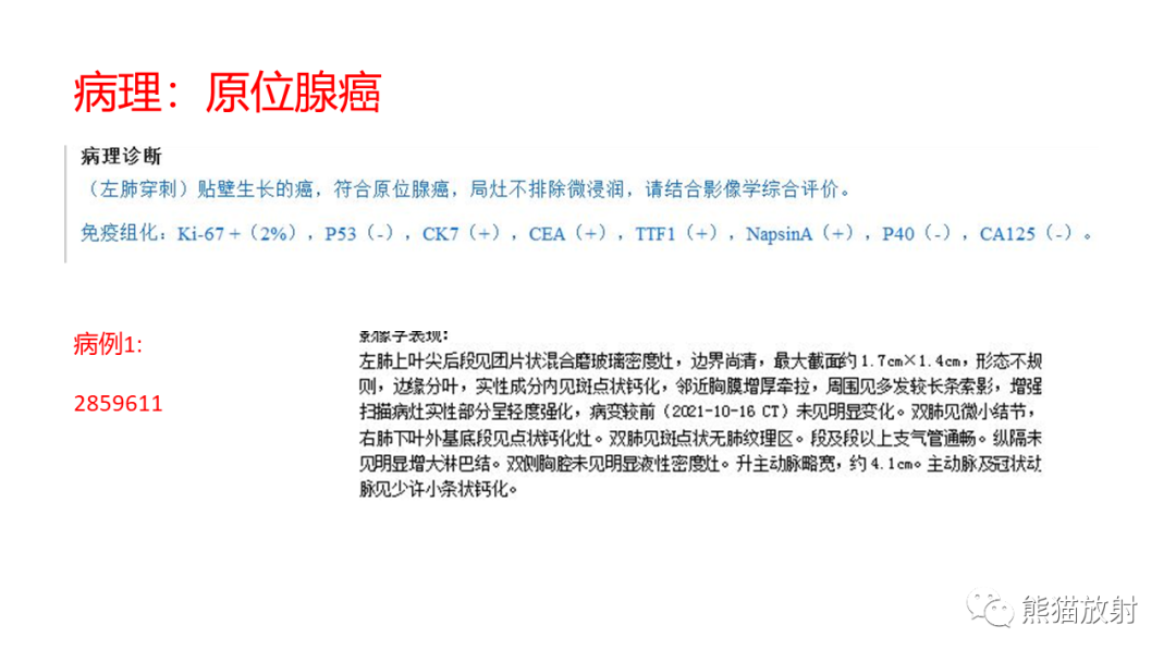 【病例】肺原位腺癌 VS 浸润性腺癌-8