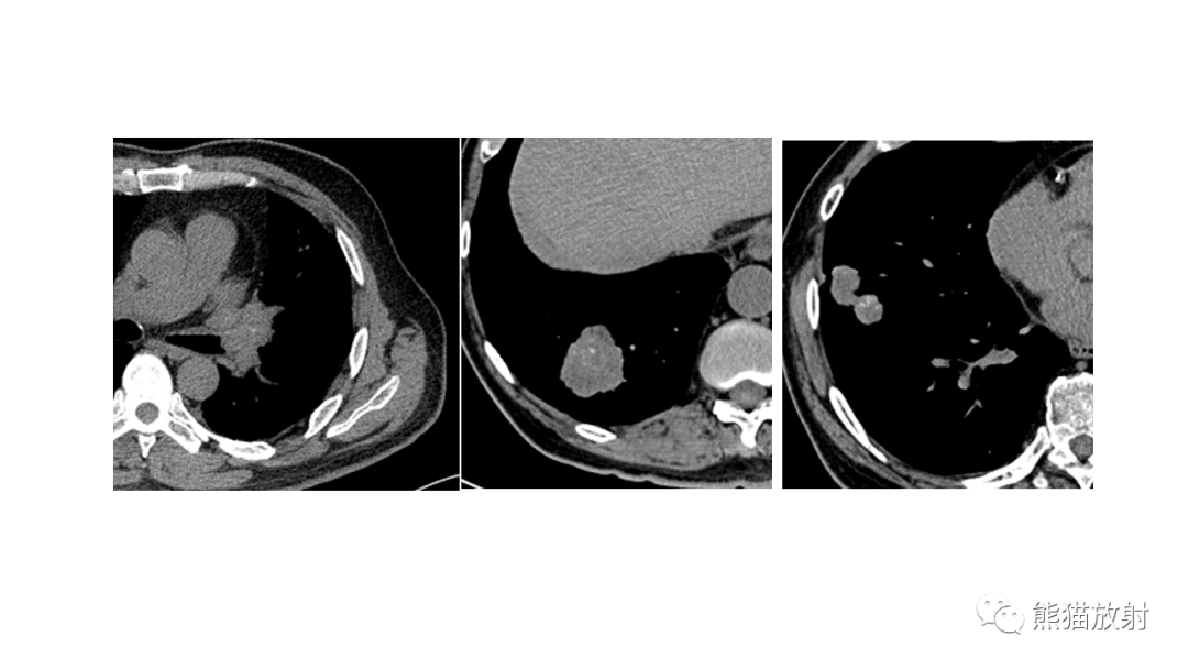 【病例】肺原位腺癌 VS 浸润性腺癌-13