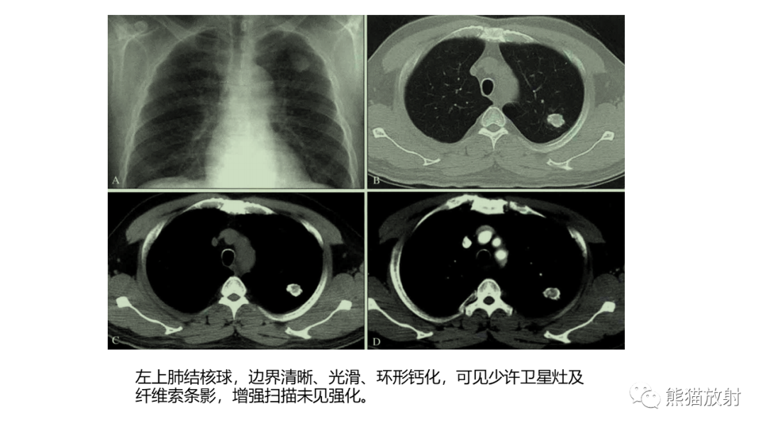 【病例】肺原位腺癌 VS 浸润性腺癌-15