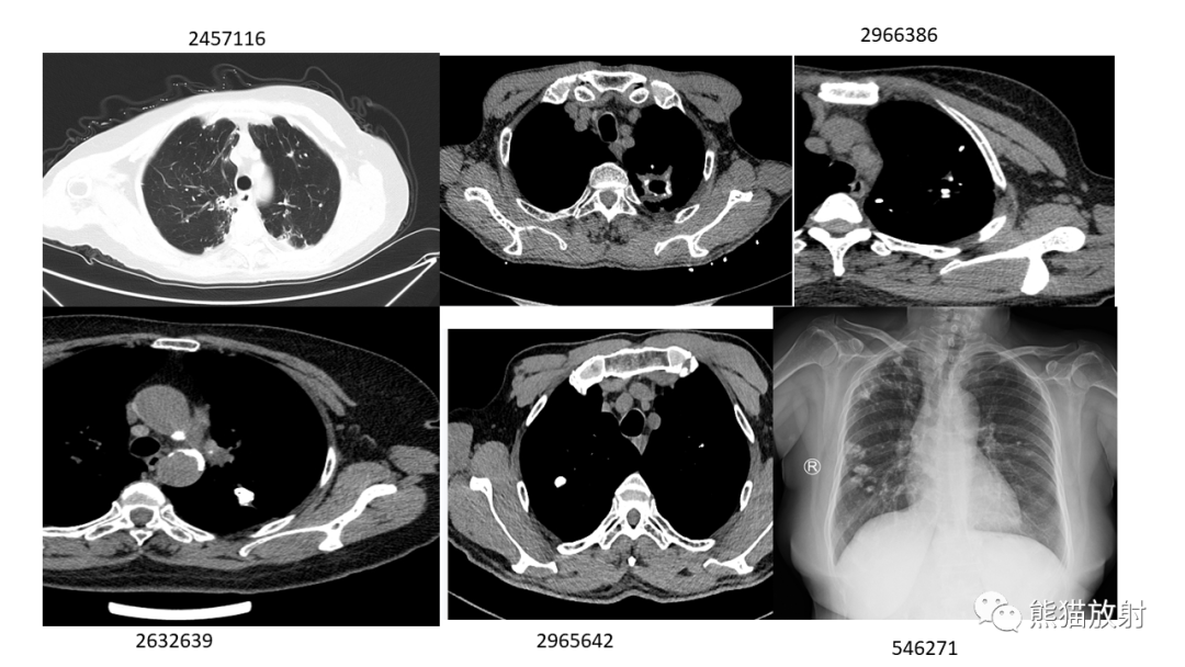 【病例】肺原位腺癌 VS 浸润性腺癌-16