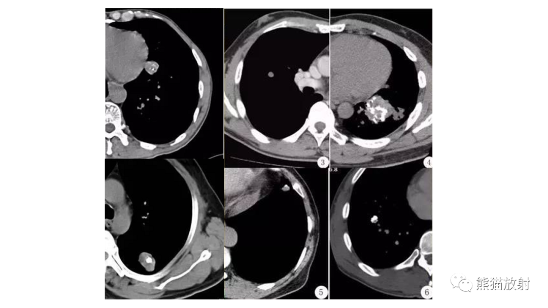 【病例】肺原位腺癌 VS 浸润性腺癌-18