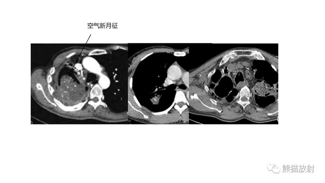 【病例】肺原位腺癌 VS 浸润性腺癌-20