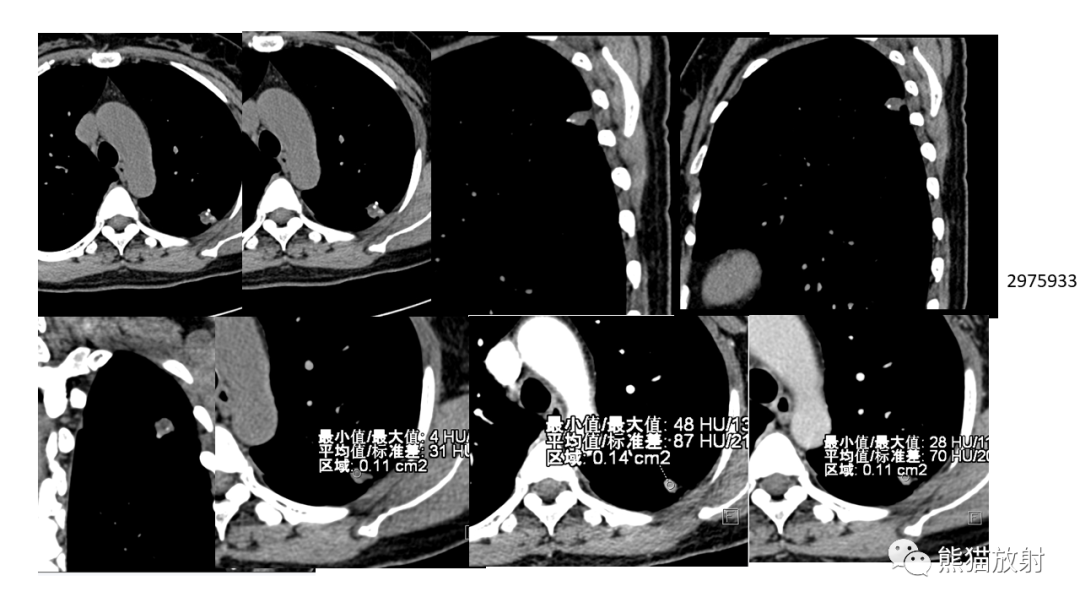 【病例】肺原位腺癌 VS 浸润性腺癌-22