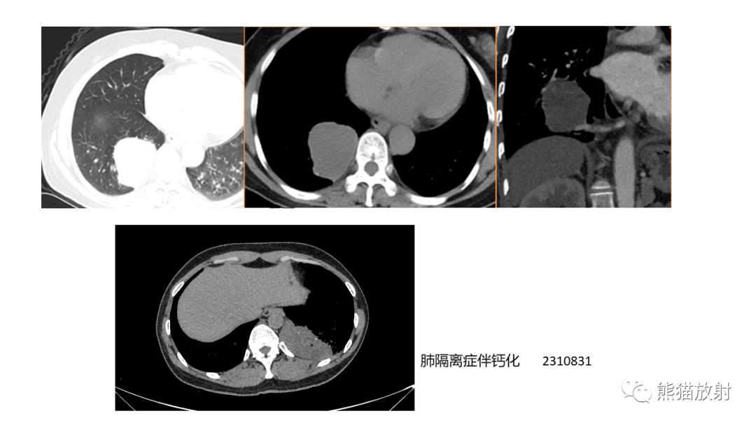【病例】肺原位腺癌 VS 浸润性腺癌-24