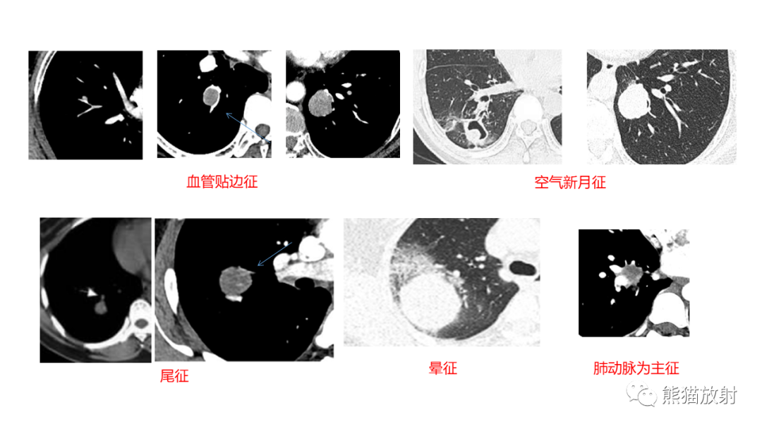 【病例】肺原位腺癌 VS 浸润性腺癌-26