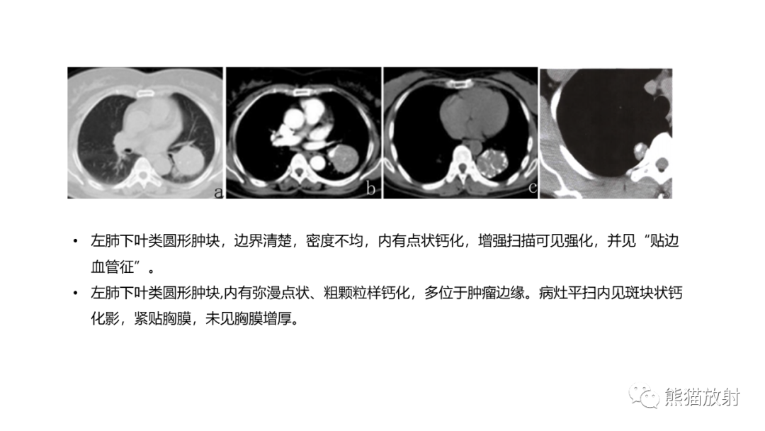 【病例】肺原位腺癌 VS 浸润性腺癌-27