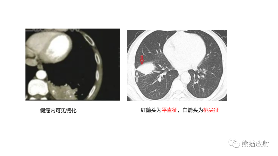 【病例】肺原位腺癌 VS 浸润性腺癌-29