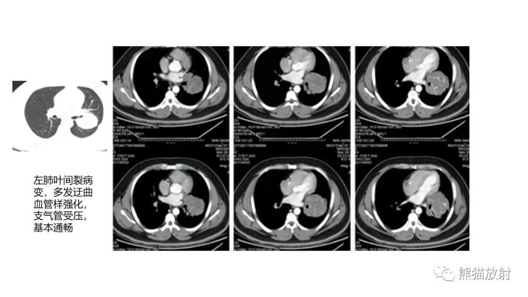 【病例】肺原位腺癌 VS 浸润性腺癌-31