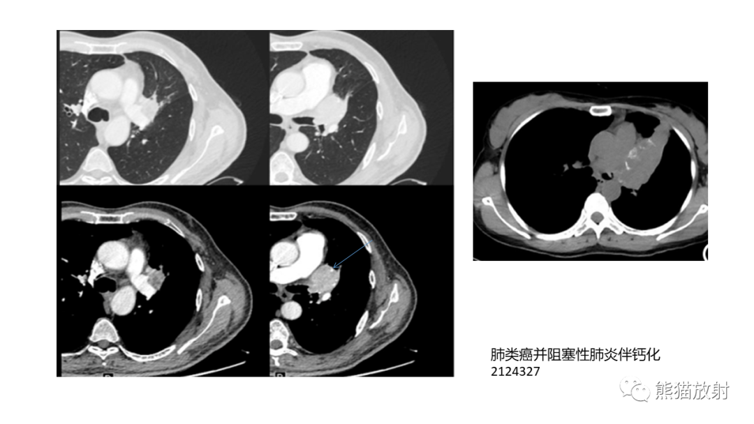 【病例】肺原位腺癌 VS 浸润性腺癌-33