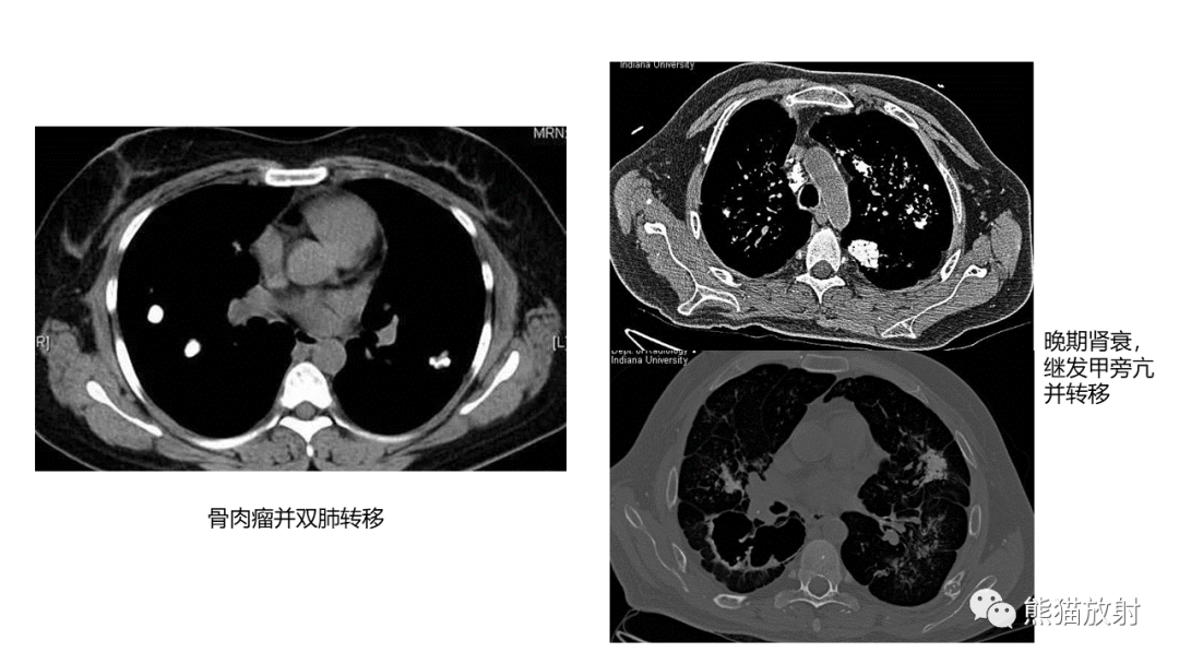 【病例】肺原位腺癌 VS 浸润性腺癌-35
