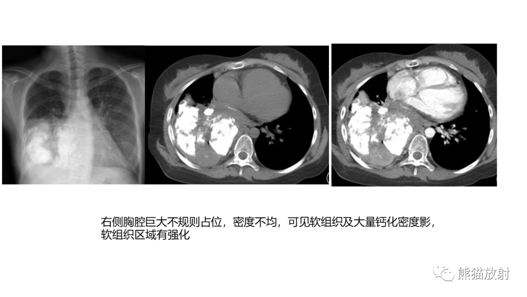 【病例】肺原位腺癌 VS 浸润性腺癌-37