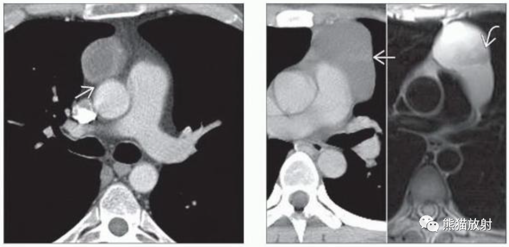 胸腺瘤、胸腺恶性肿瘤影像表现-3