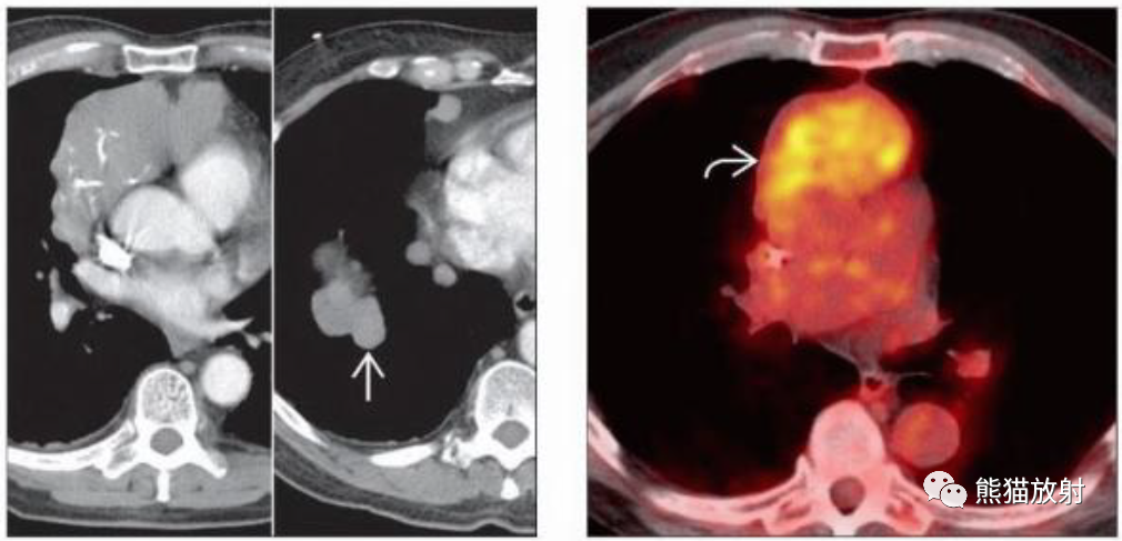胸腺瘤、胸腺恶性肿瘤影像表现-5