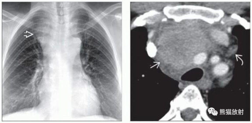 胸腺瘤、胸腺恶性肿瘤影像表现-6