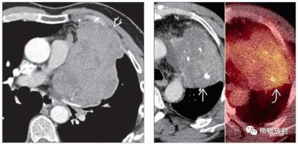 胸腺瘤、胸腺恶性肿瘤影像表现-7