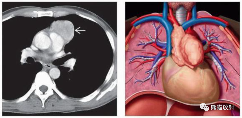 胸腺瘤、胸腺恶性肿瘤影像表现-2