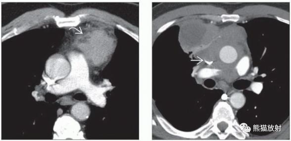 胸腺瘤、胸腺恶性肿瘤影像表现-3
