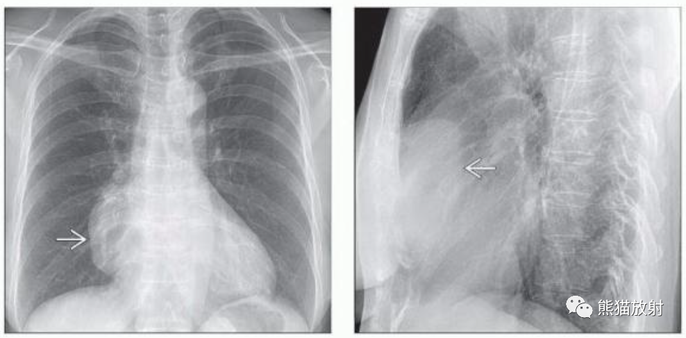 胸腺瘤、胸腺恶性肿瘤影像表现-1