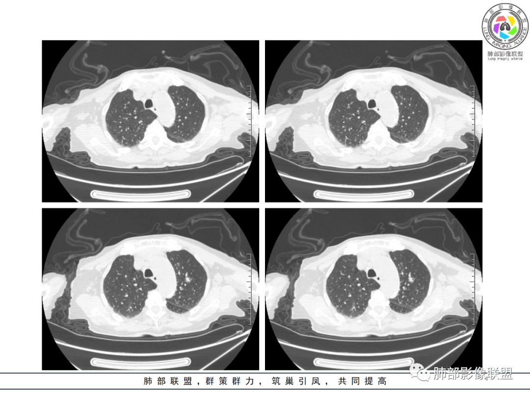 【病例】围绕中轴间质的弥漫大B淋巴瘤-4