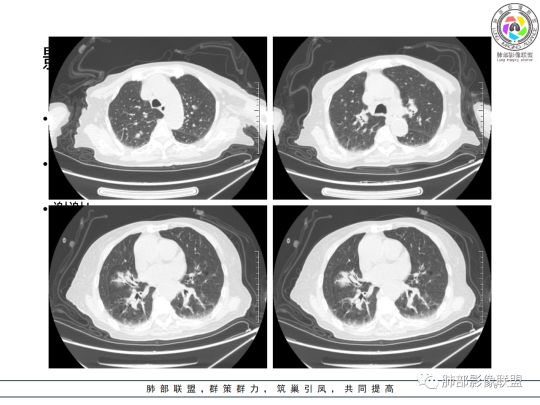 【病例】围绕中轴间质的弥漫大B淋巴瘤-5