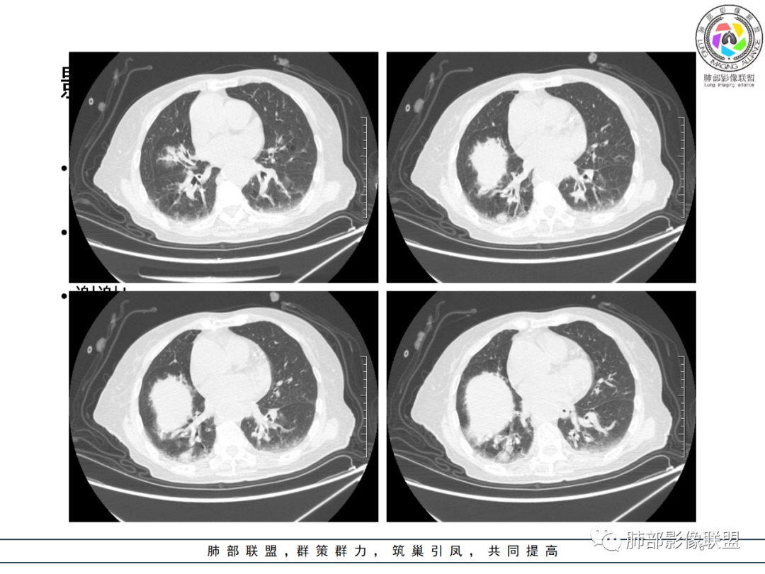 【病例】围绕中轴间质的弥漫大B淋巴瘤-6