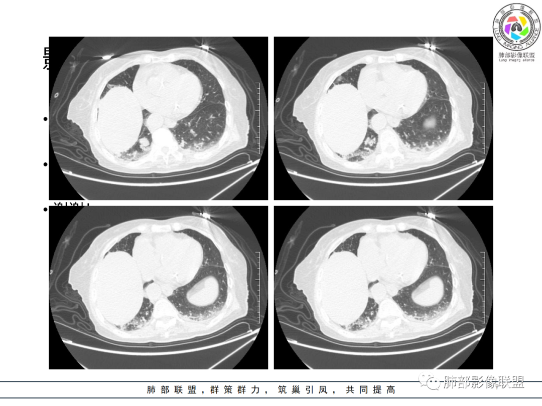 【病例】围绕中轴间质的弥漫大B淋巴瘤-7