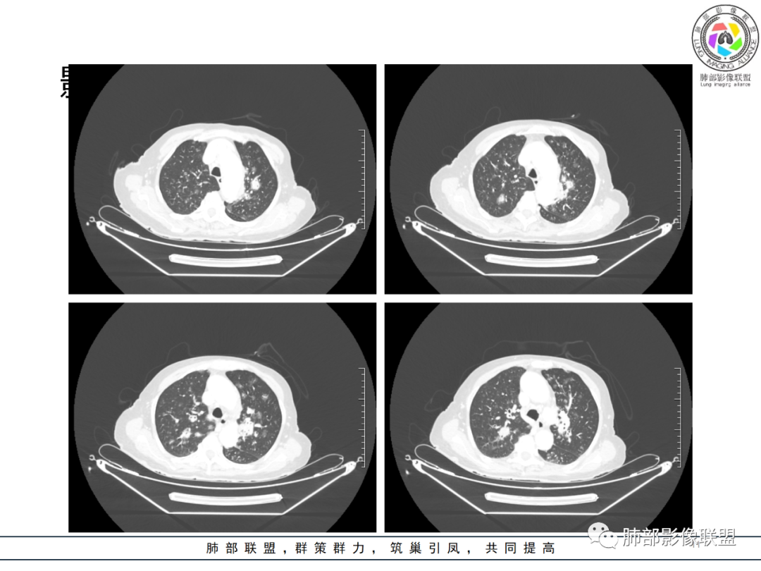 【病例】围绕中轴间质的弥漫大B淋巴瘤-11