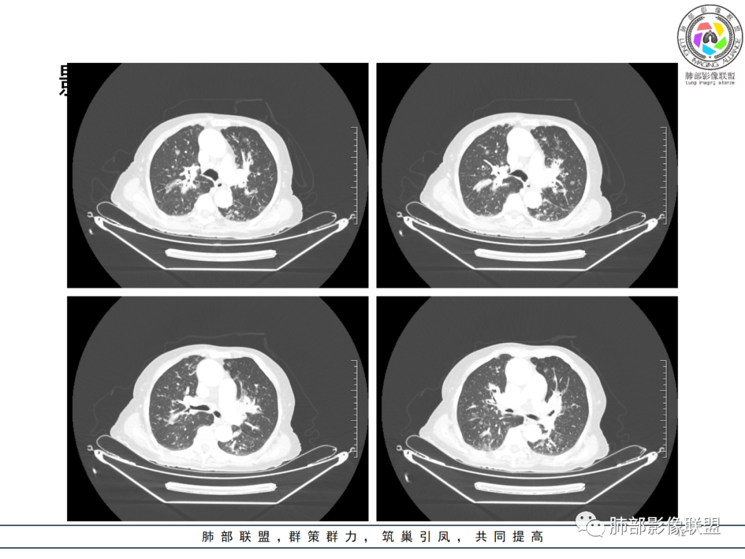 【病例】围绕中轴间质的弥漫大B淋巴瘤-12