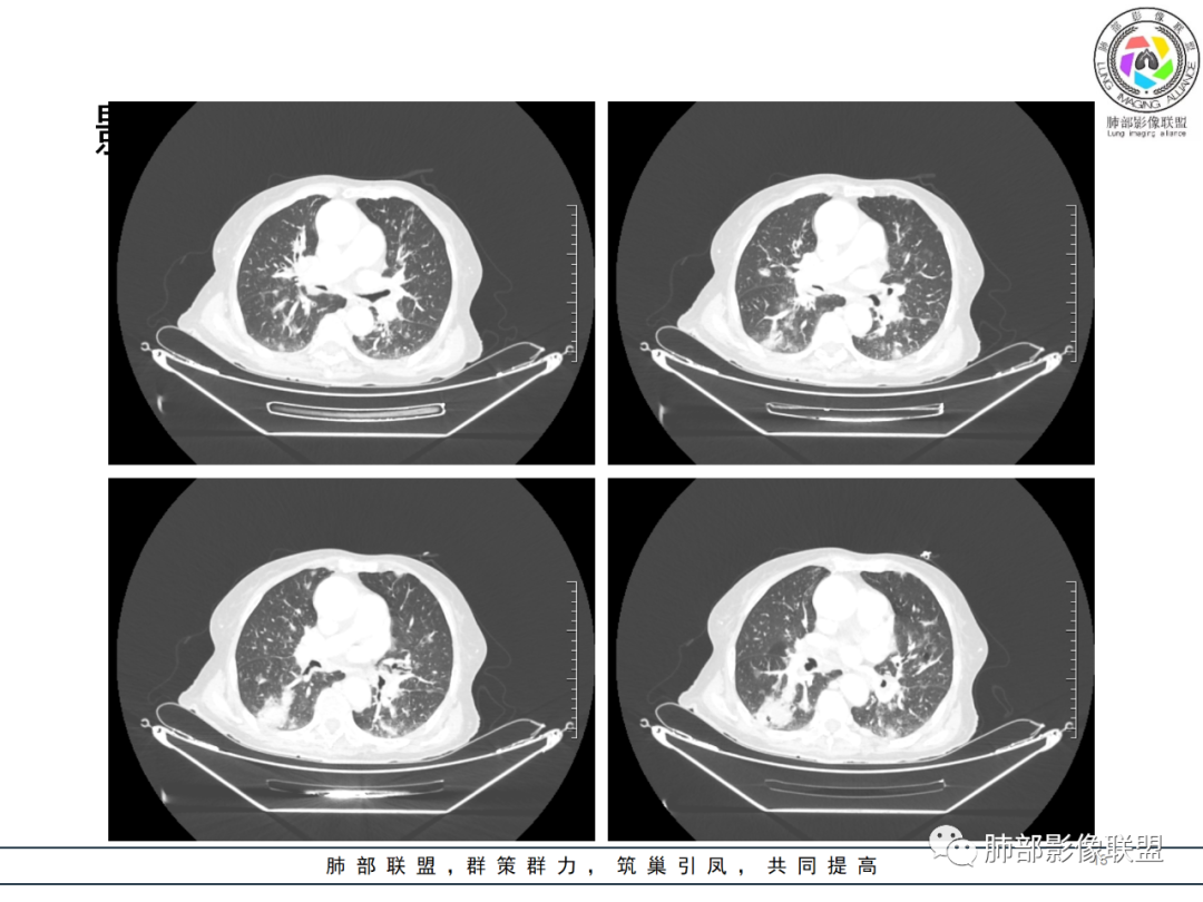 【病例】围绕中轴间质的弥漫大B淋巴瘤-13
