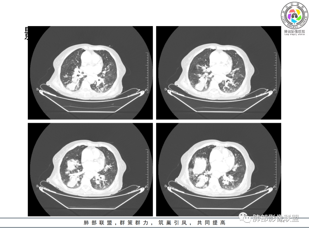 【病例】围绕中轴间质的弥漫大B淋巴瘤-14