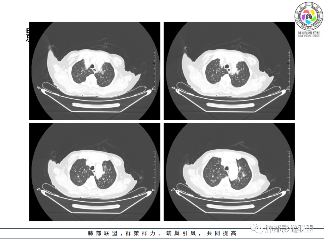 【病例】围绕中轴间质的弥漫大B淋巴瘤-10