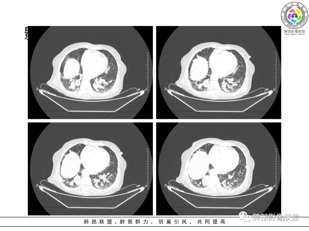 【病例】围绕中轴间质的弥漫大B淋巴瘤-15