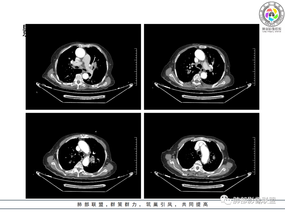 【病例】围绕中轴间质的弥漫大B淋巴瘤-17