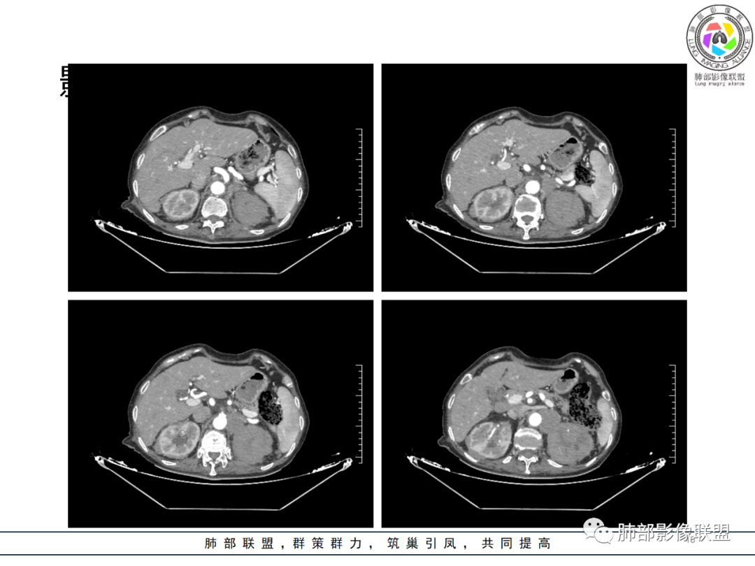 【病例】围绕中轴间质的弥漫大B淋巴瘤-18