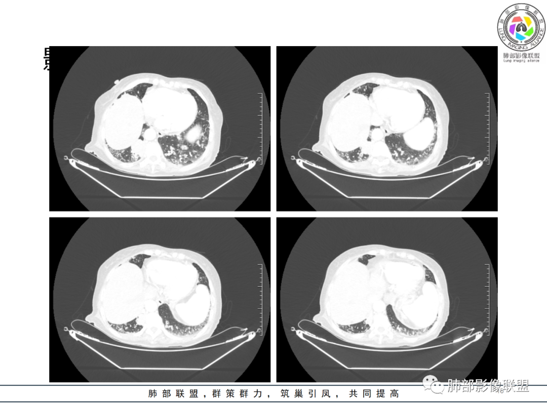 【病例】围绕中轴间质的弥漫大B淋巴瘤-16